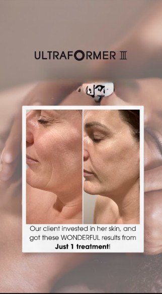 HIFU Before and After Results - Just 1 Treatment